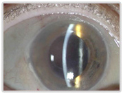 Descemets Stripping Endothelial Keratoplasty Surgery, Descemet's Stripping, Endothelial Keratoplasty